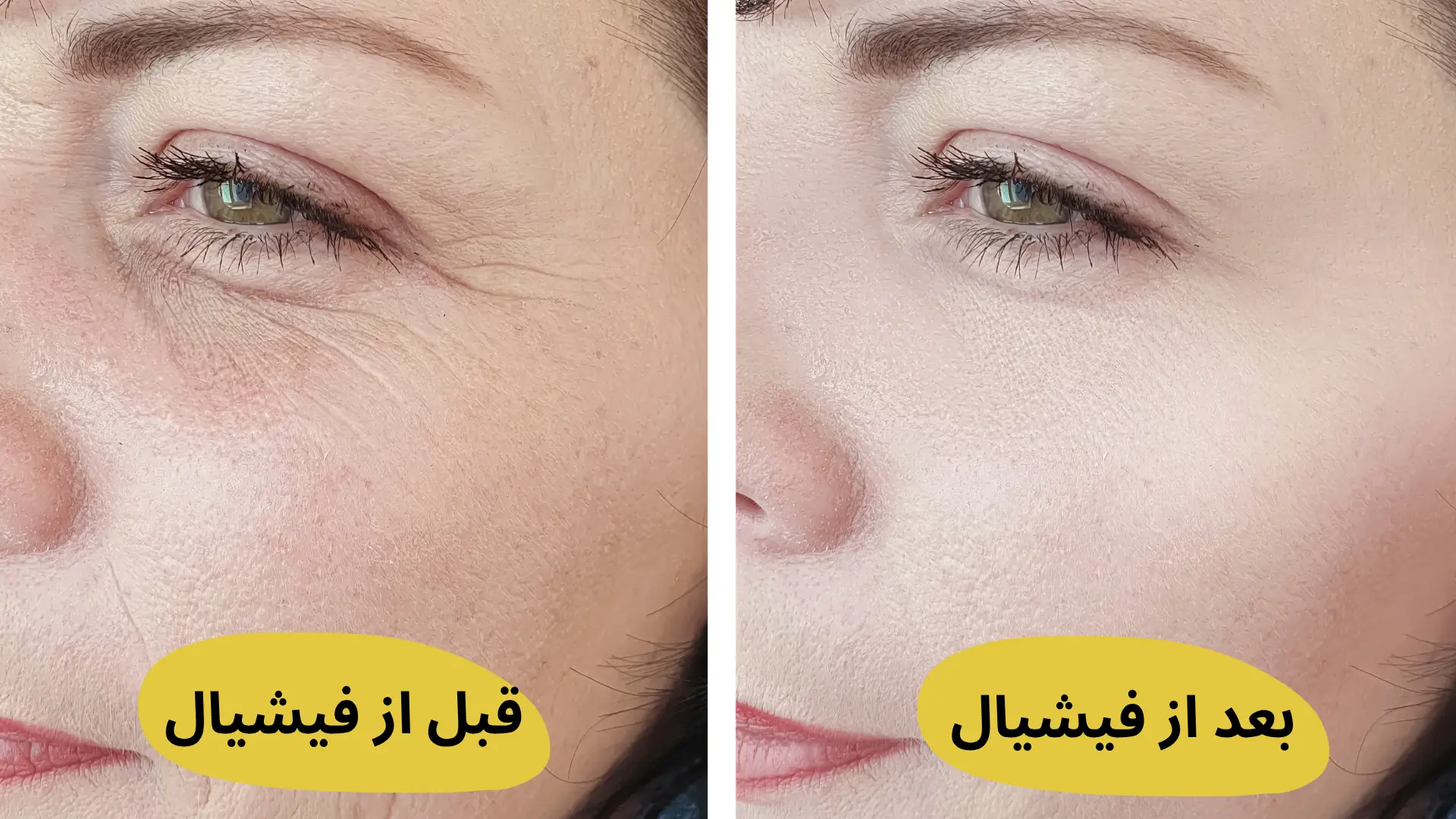 قبل و بعد از فیشیال